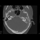 Mastoiditis, mesotitis: CT - Computed tomography